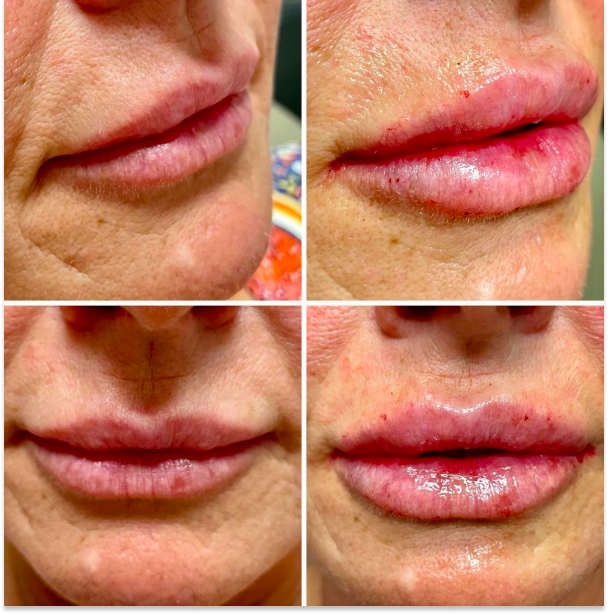 Injectables Filler 3