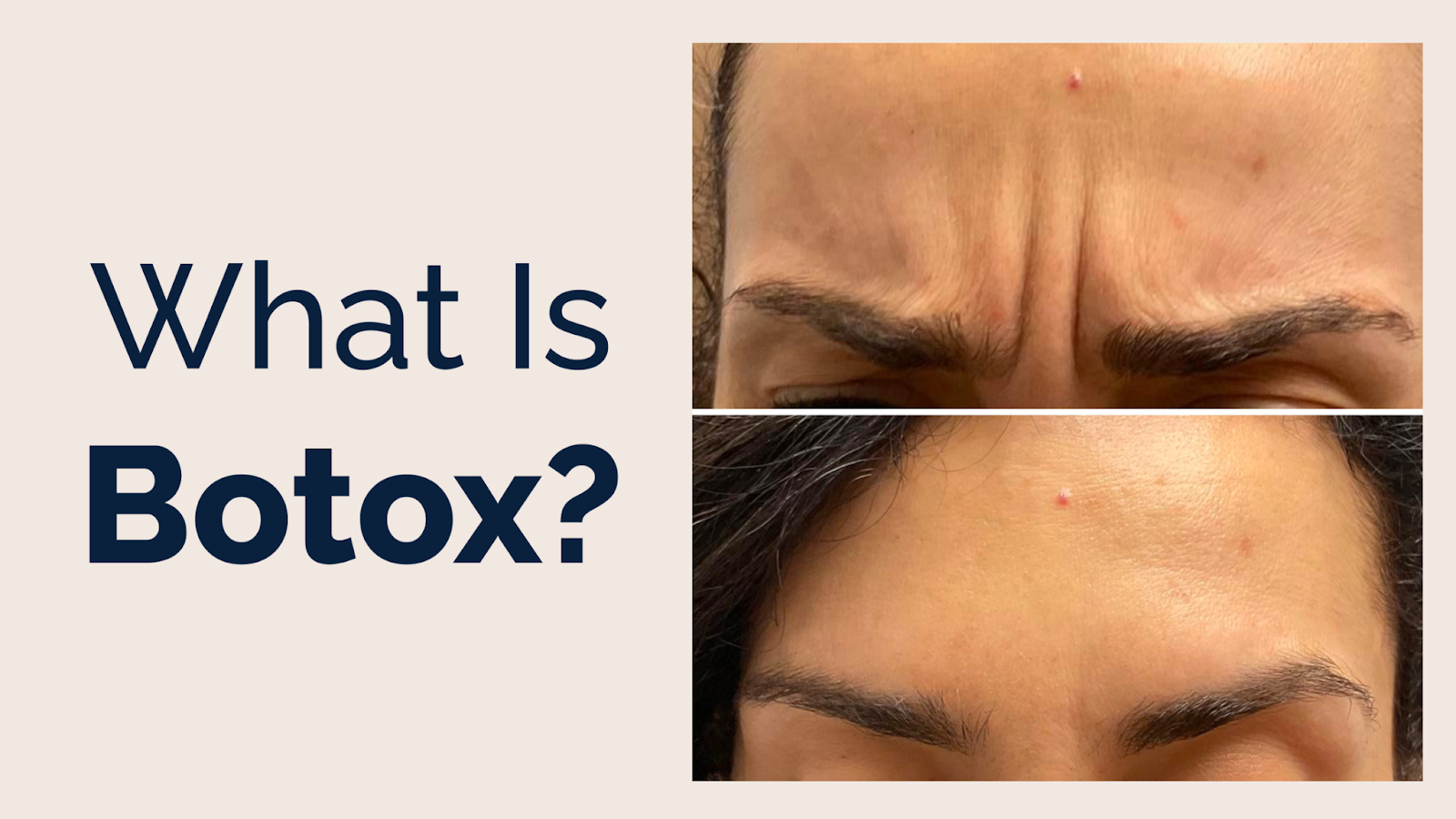 What is Botox?
