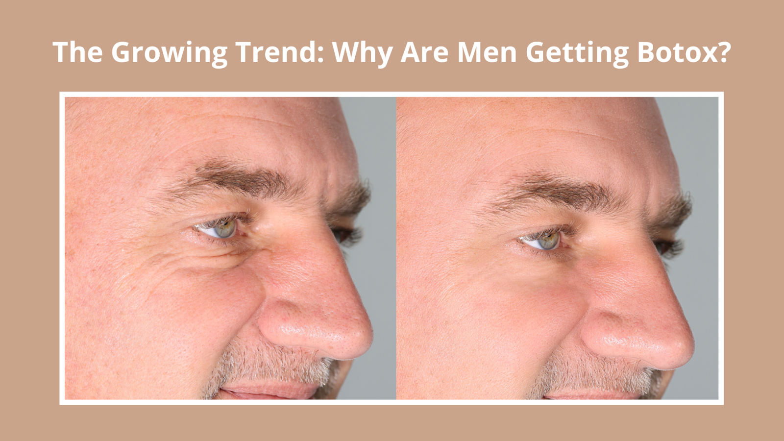 Before and after Botox image