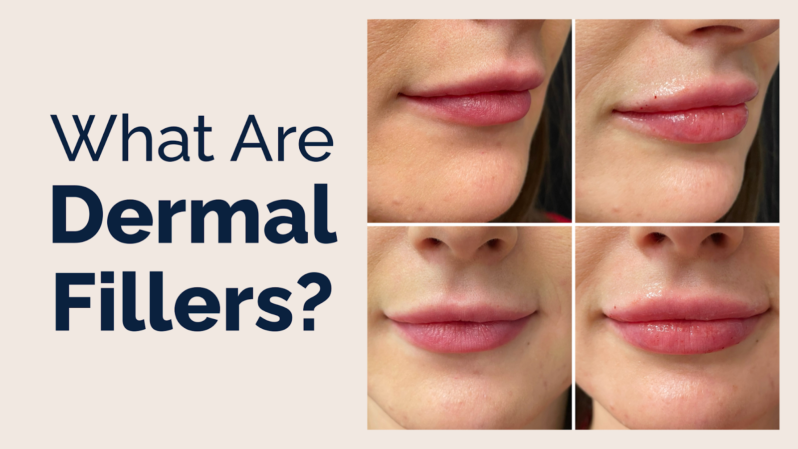 What are Dermal Fillers?