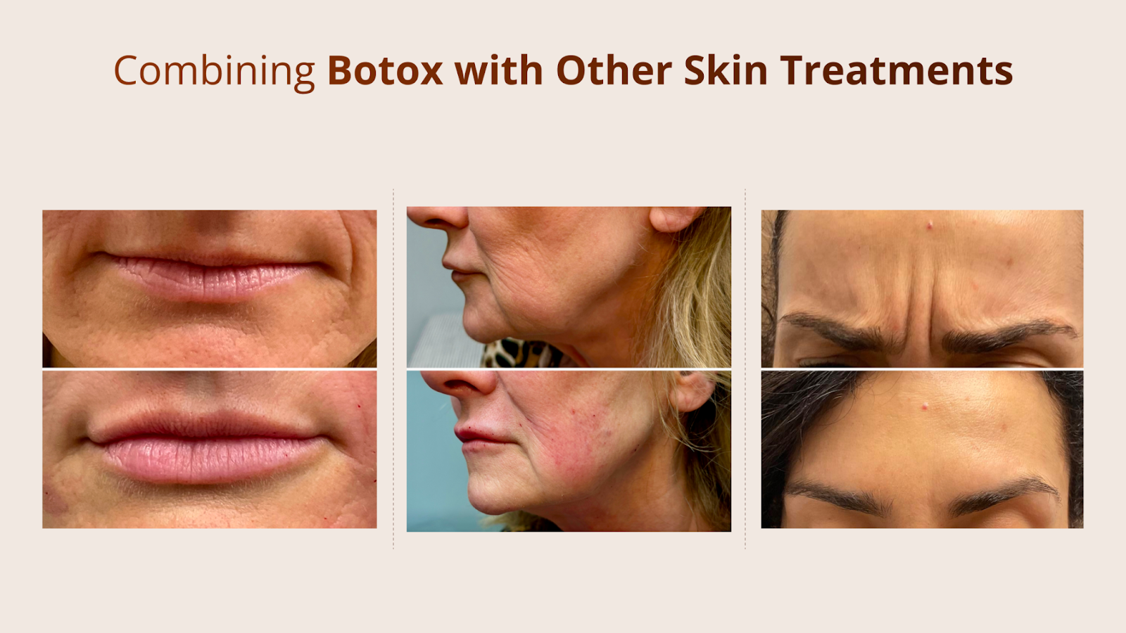 Combining Botox with Other Skin Treatments